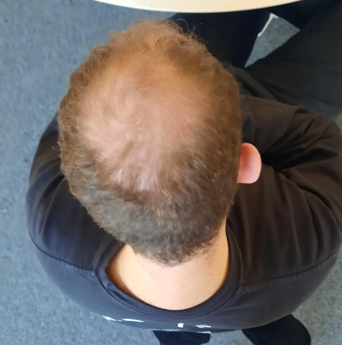 מבט מלמעלה על ראשו של גבר עם דילול בקודקוד, כתוצאה ממיניאטוריזציה של זקיקים