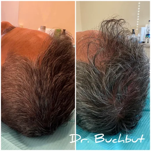 לפני ואחרי טיפול בדילול שיער פזור בכל אזורי הראש, גבר (19 מתוך 31)
