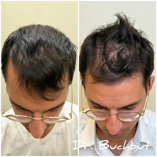 לפני ואחרי טיפול בדילול שיער בחלק הקדמי של הראש, גבר (58 מתוך 159)