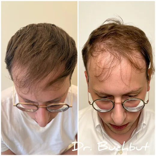 לפני ואחרי טיפול בדילול שיער בחלק הקדמי של הראש, גבר (43 מתוך 159)