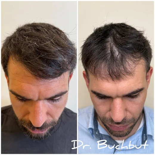 לפני ואחרי טיפול בדילול שיער בחלק הקדמי של הראש, גבר (140 מתוך 159)