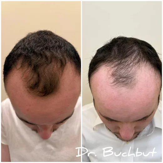 לפני ואחרי טיפול בדילול שיער בחלק הקדמי של הראש, גבר (3 מתוך 159)
