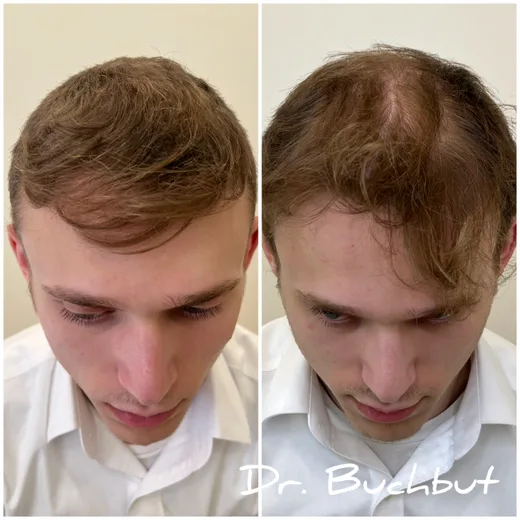 לפני ואחרי טיפול בדילול שיער בחלק הקדמי של הראש, גבר (122 מתוך 159)