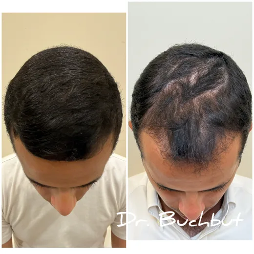 לפני ואחרי טיפול בדילול שיער בחלק הקדמי ובכתר של הראש, גבר (17 מתוך 25)