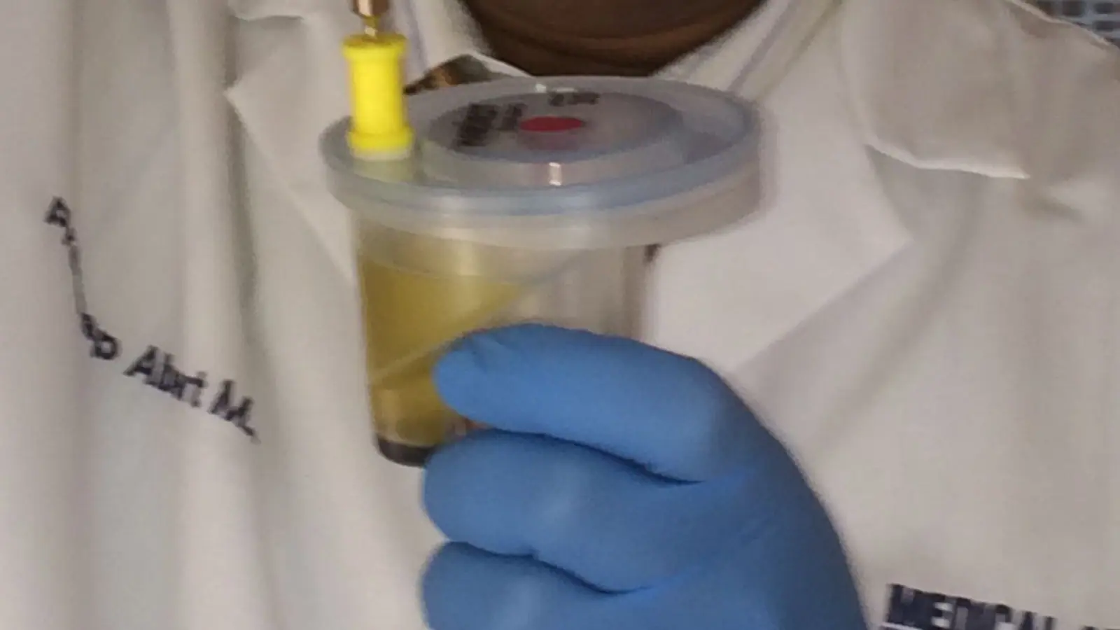 יד בכפפה כחולה מחזיקה מיכל שקוף עם פלזמה צהבהבה שהופרדה מהדם