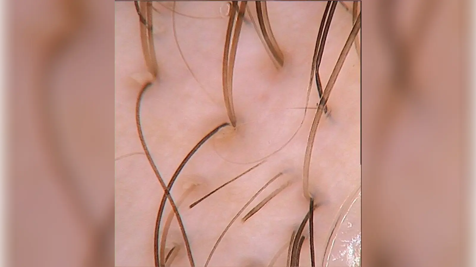 צילום טריכוסקופי בהגדלה של קרקפת: שערות ופתחי זקיקים, כפי שרואים בבדיקת טריכוסקופיה